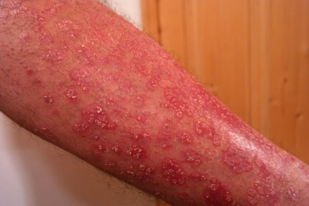 Psoriasis y sus causas emocionales - Blog - Laura Casart