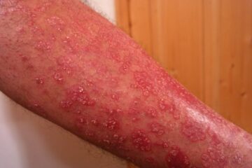 Psoriasis y sus causas emocionales - Blog - Laura Casart