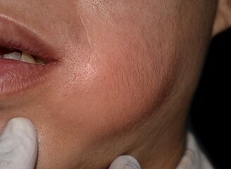 Causas Emocionales del Flemón o Absceso Bucal