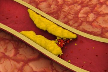 Causas emocionales de la arterioesclerosis según la biodescodificación y su relación con rigidez emocional y desvalorización.